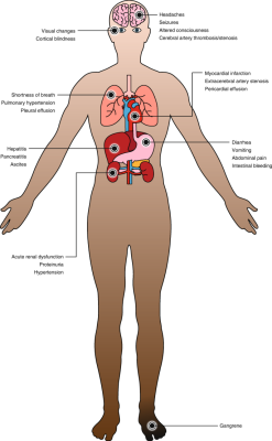 In most cases, organ damage may occur following the administration of drugs used in chemotherapy and the preparation regimen for hematopoietic stem cell transplantation, total body radiotherapy (TBI), and chronic graft-versus-host disease (GVHD).