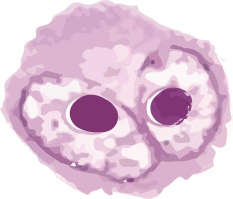 Hodgkin's lymphoma & Non-Hodgkin's lymphoma