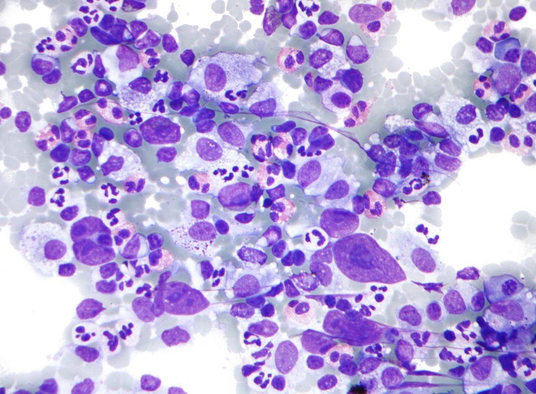 Hodgkin's lymphoma& Non-Hodgkin's lymphoma