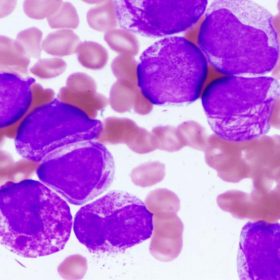 Acute Promyelocytic Leukemia بیماری لوسمی حاد پرومیلوسیتیک  PML-RAR, acute myeloid leukemia