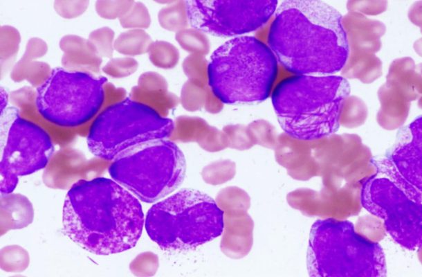 Acute Promyelocytic Leukemia بیماری لوسمی حاد پرومیلوسیتیک  PML-RAR, acute myeloid leukemia